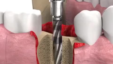 New Dental Implant New Machine Technology
