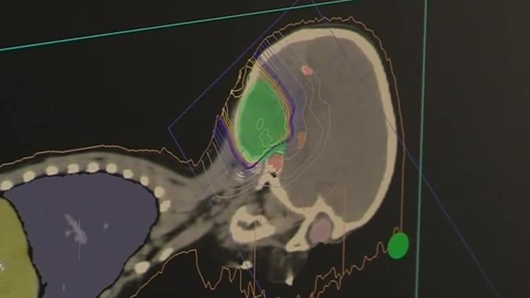 Cancer-zapping proton therapy delivers advanced tumour targeting