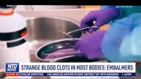 Giant Blood Clots Are in in 50% to 70% of all Deaths