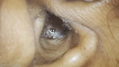 SPIDER CRAWLS OUT OF WOMAN'S EAR