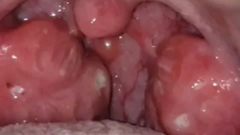 Nicotine Tonsil Destruction