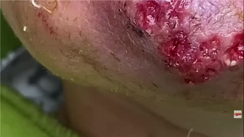 CYSTIC ACNE HUGE CYSTS DRAINED CARBUNCLE