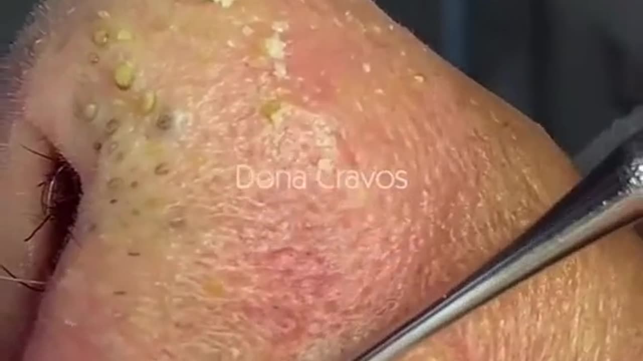 Blackhead removal