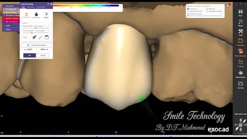 #design #naildesign #dental #dentaldesign #exocadexpert