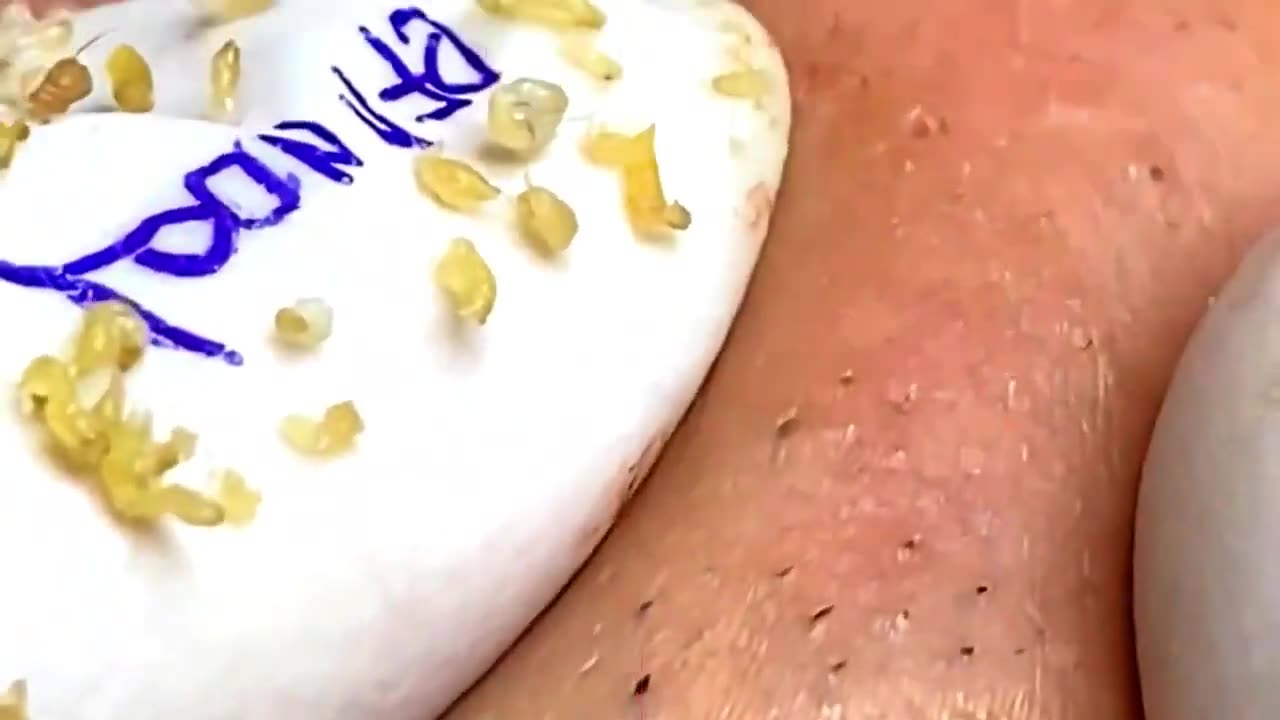 blackheads popping