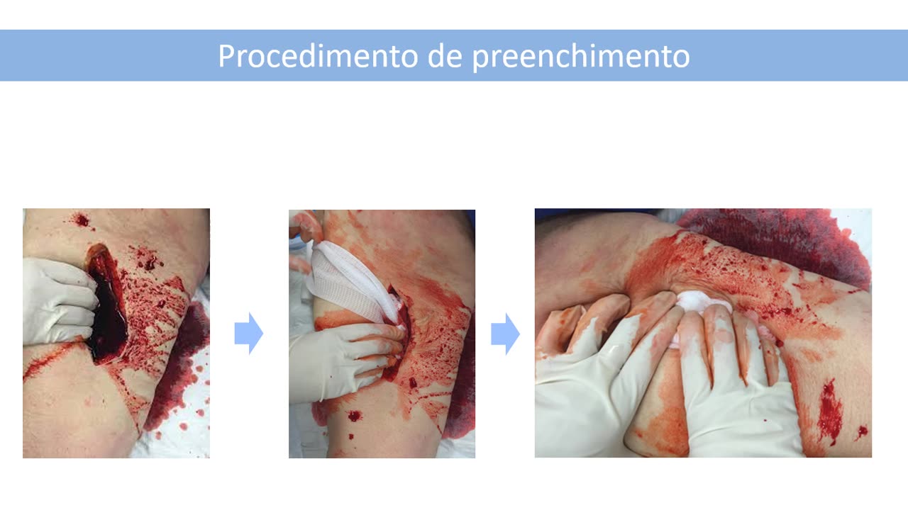 Via Verde Trauma - Aula 5 - Preenchimento em Hemorragias