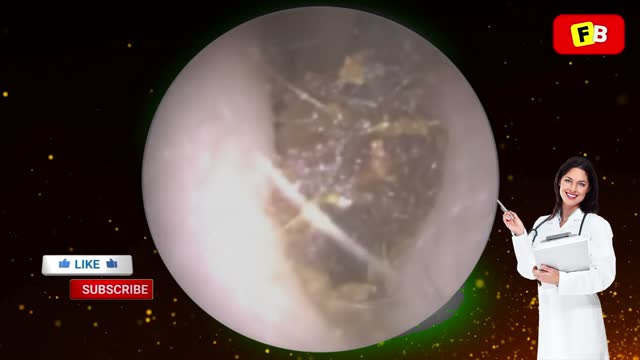 Ear Wax Removal PART 13