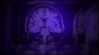 Alzheimers drug slows cognitive decline