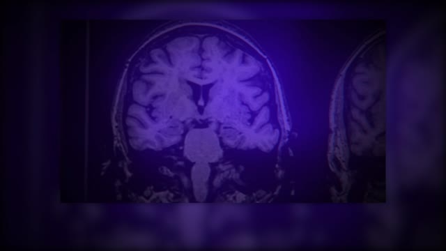 Alzheimers drug slows cognitive decline