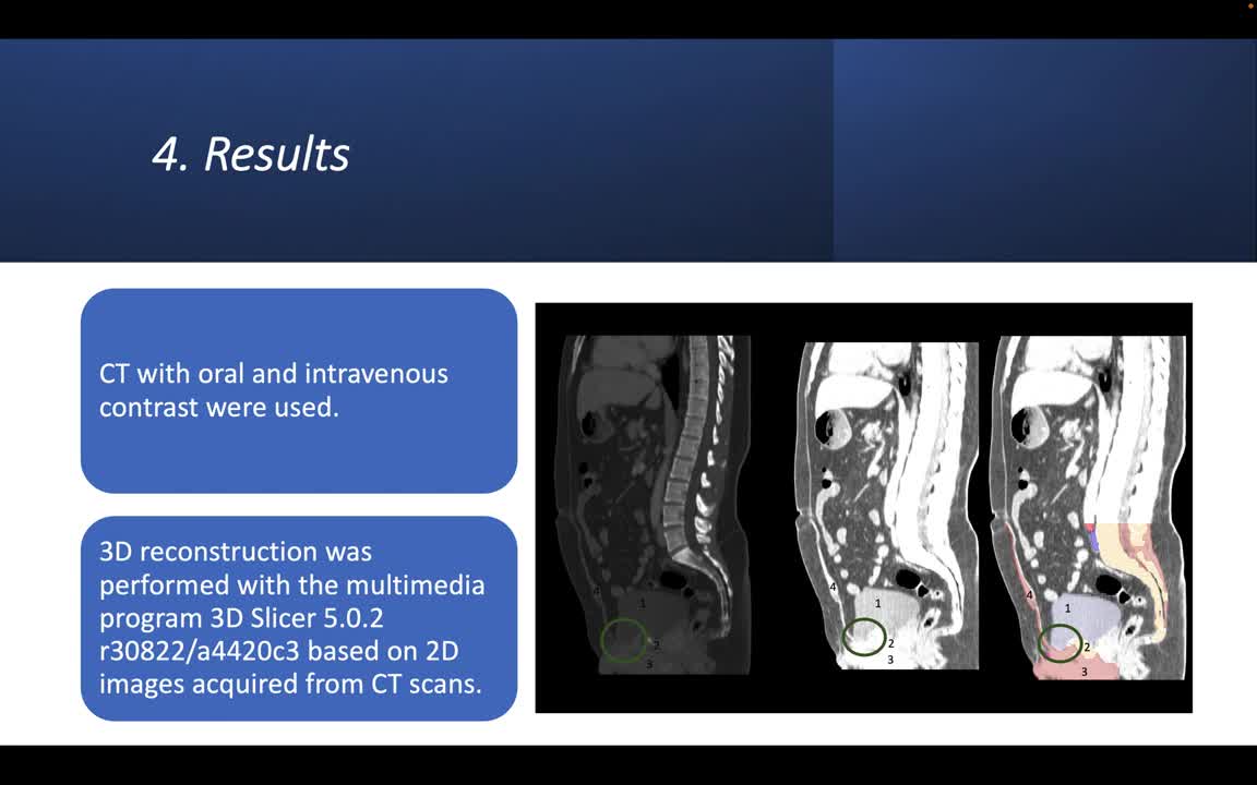 ID159 - Complex abdominal wall disorders treated using 3D technology