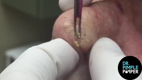 8 MINUTES OF SATISFYING POPS with Dr Sandra Lee / Dr Pimple Popper