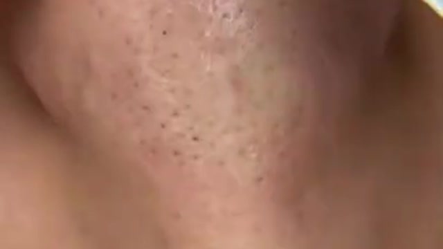 Acne Treatment 2022#Technicalexpertguru