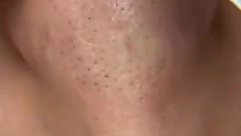 Acne Treatment 2022#Technicalexpertguru