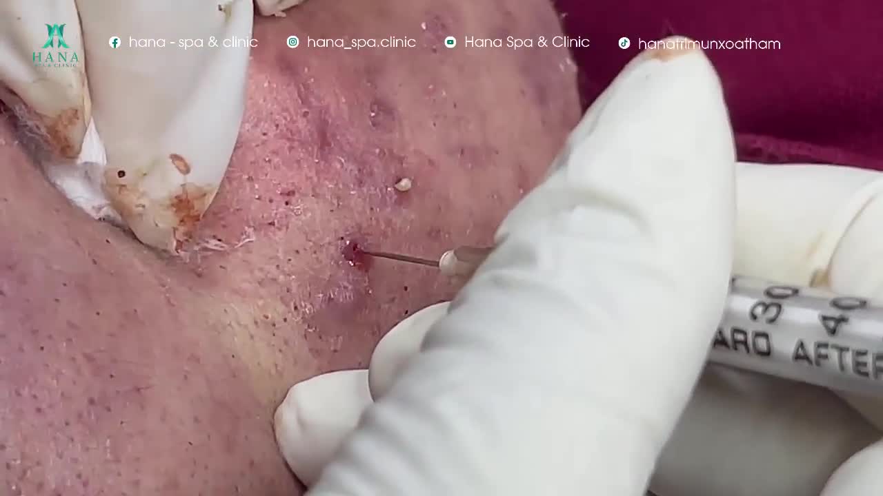 Big Cystic Acne Blackheads Extraction Blackheads & Milia, Whiteheads Removal Pimple Popping