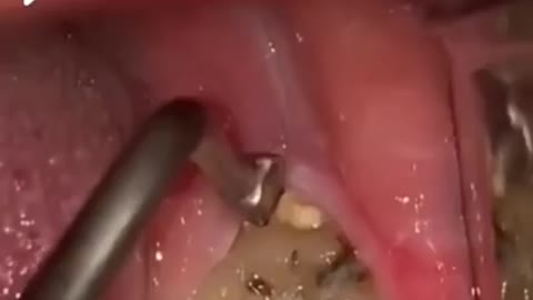 Wisdom tooth pain