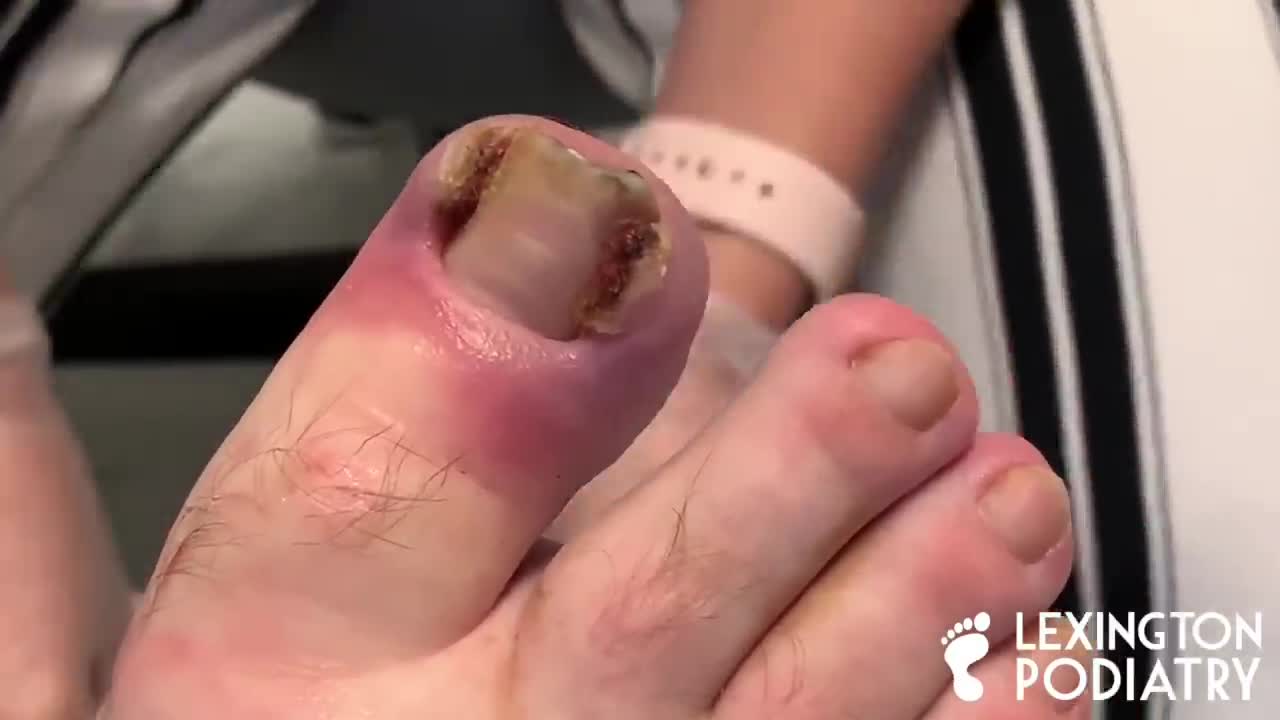 DEEP + BLOODY INGROWN TOENAIL