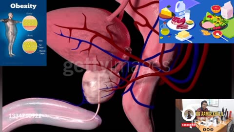 Gallstone (cholelithiasis) Explained By Dr Aamir