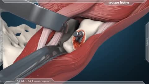 Anterior Approach Dual Mobility Acetabular Component 3D Animation