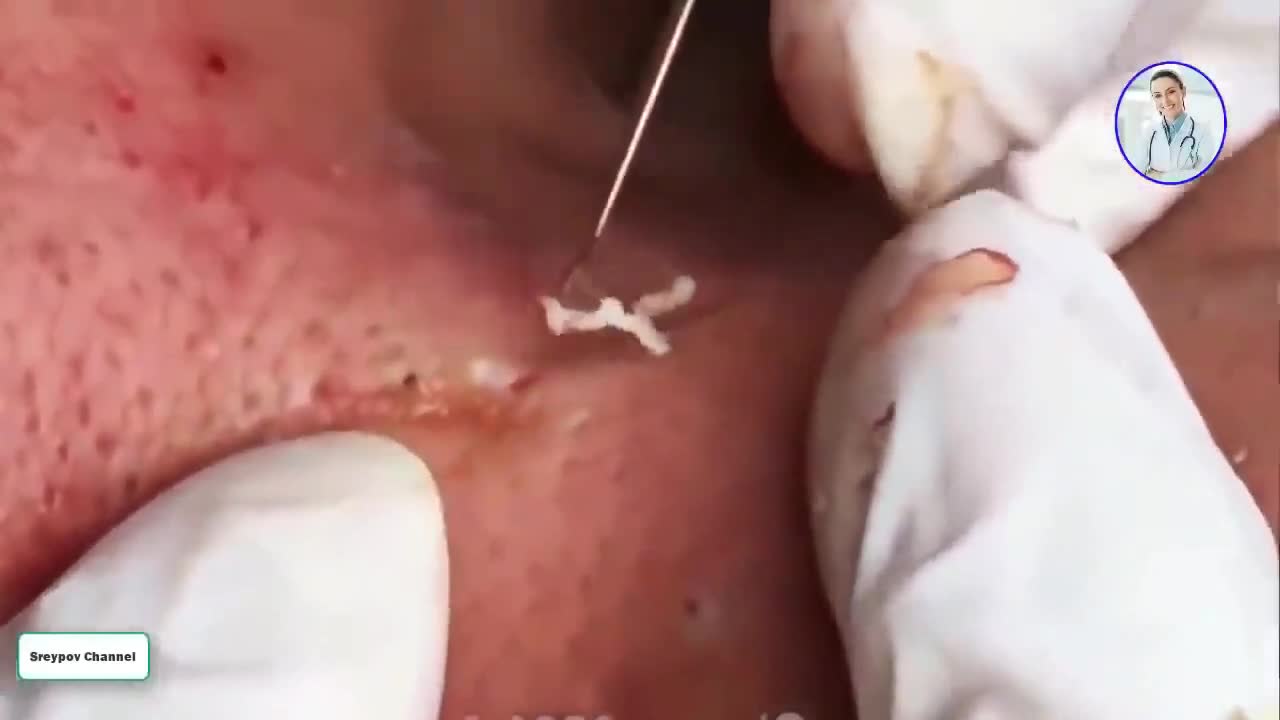 BIGGEST BLACKHEAD EVER SEEN!!