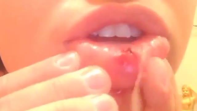 Cyst gushing out from an infected piercing under her lip