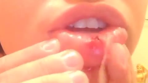 Cyst gushing out from an infected piercing under her lip