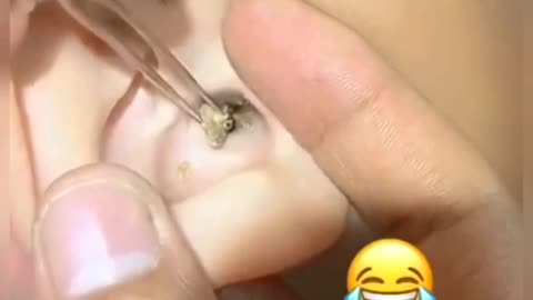 Blackhead in ear