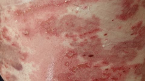 Ralph’s Story - My Experience With The Astra Zeneca Covid-19 Vaccine