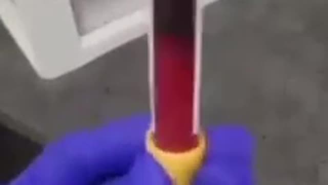 Vaxxed Person Blood Clots in 3 minutes