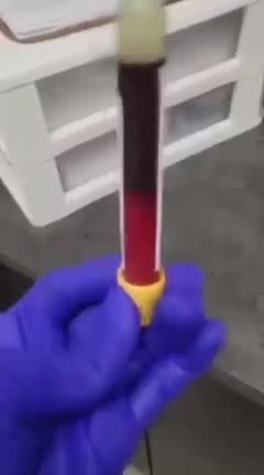 Vaxxed Person Blood Clots in 3 minutes