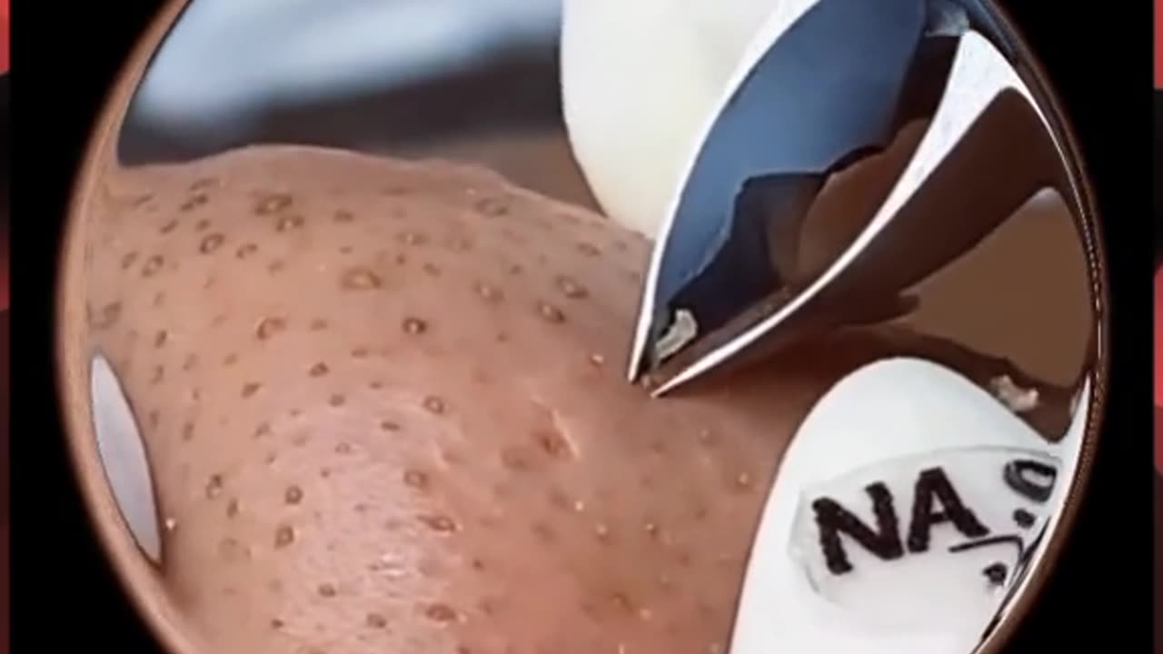 Big plPimple Blackheads Remove