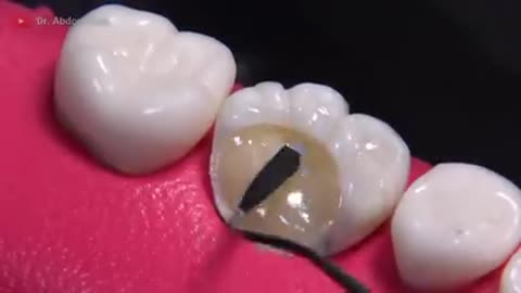 AMAZING reconstruction of tooth damaged by caries: Endodontics