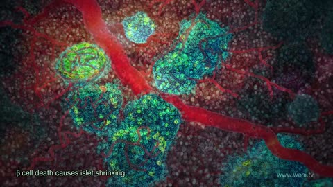 How type 2 diabetes works in your body Part 1