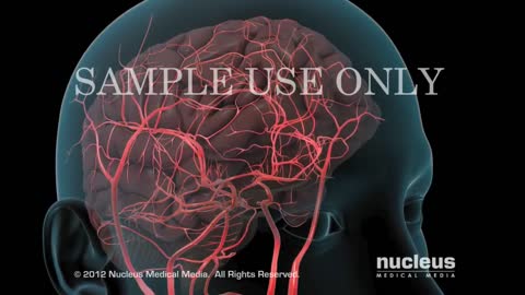 Brain Hemorrhage (Hemorrhagic Stroke)