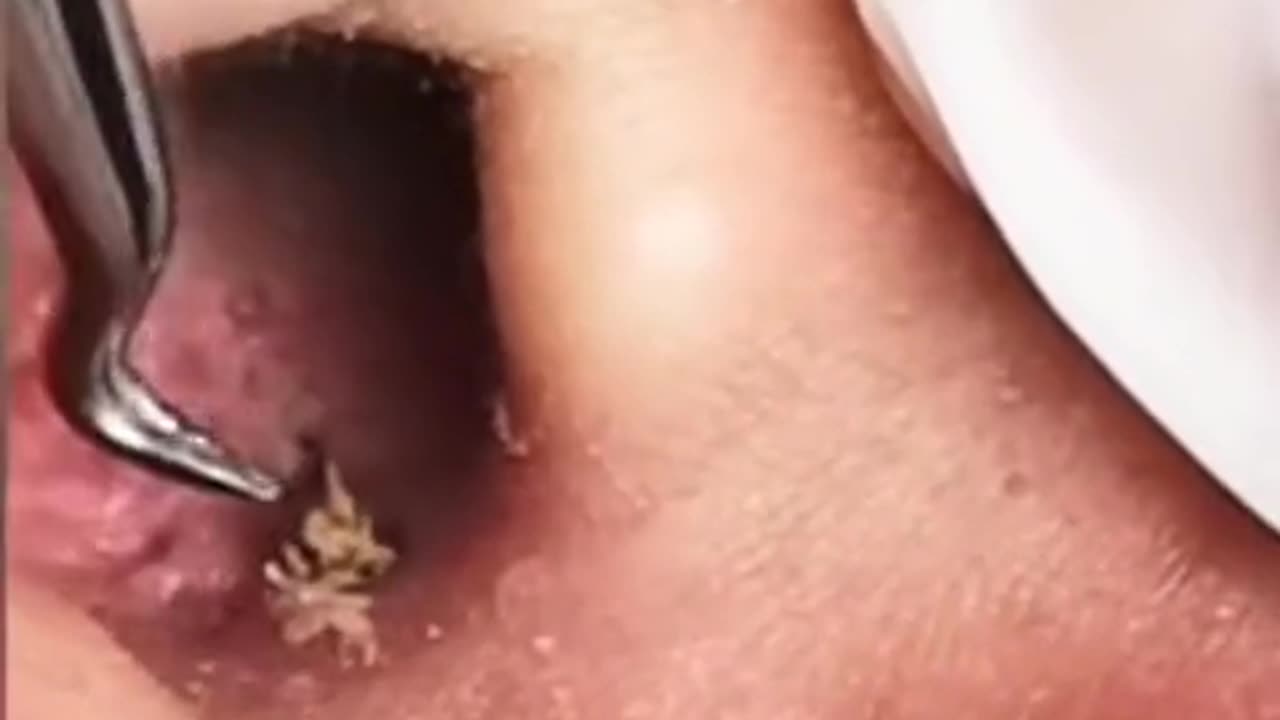 satisfying pesky blackheads removal