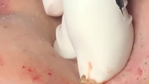 pimple popping