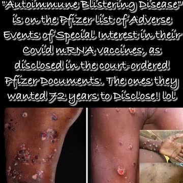 Autoimmune Blistering Disease vs. MonkeyPox 💉