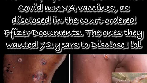 Autoimmune Blistering Disease vs. MonkeyPox 💉