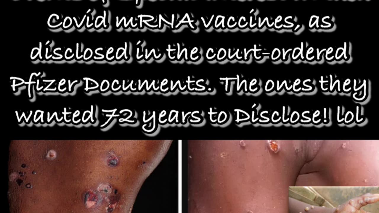 Autoimmune Blistering Disease vs. MonkeyPox 💉