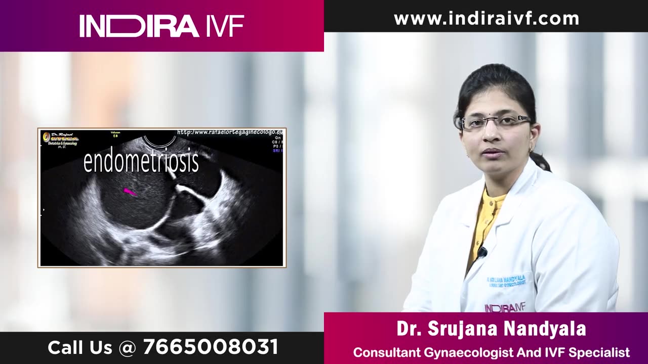 Endometriosis Causes: Know What Causes Endometriosis at Indira IVF
