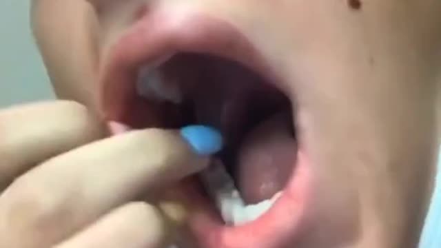 vaxx injured mouth and face sores