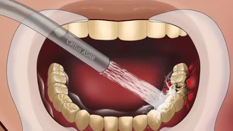 SATISFYING ASMR ( TREATMENT OF SEVERE TOOTH DECAY) @Satisfying_ ASMR _Animations