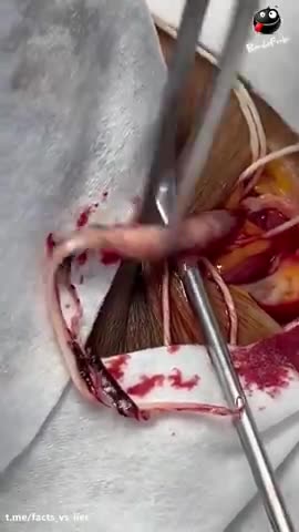 BLOOD CLOTS FROM THE SAFE AND EFFECTIVE TRUMP INJECTION