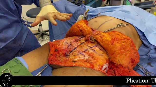 360° Circumferential Lower Body Lift with Dermal Flap & Modified Longitudinal Thigh Reduction