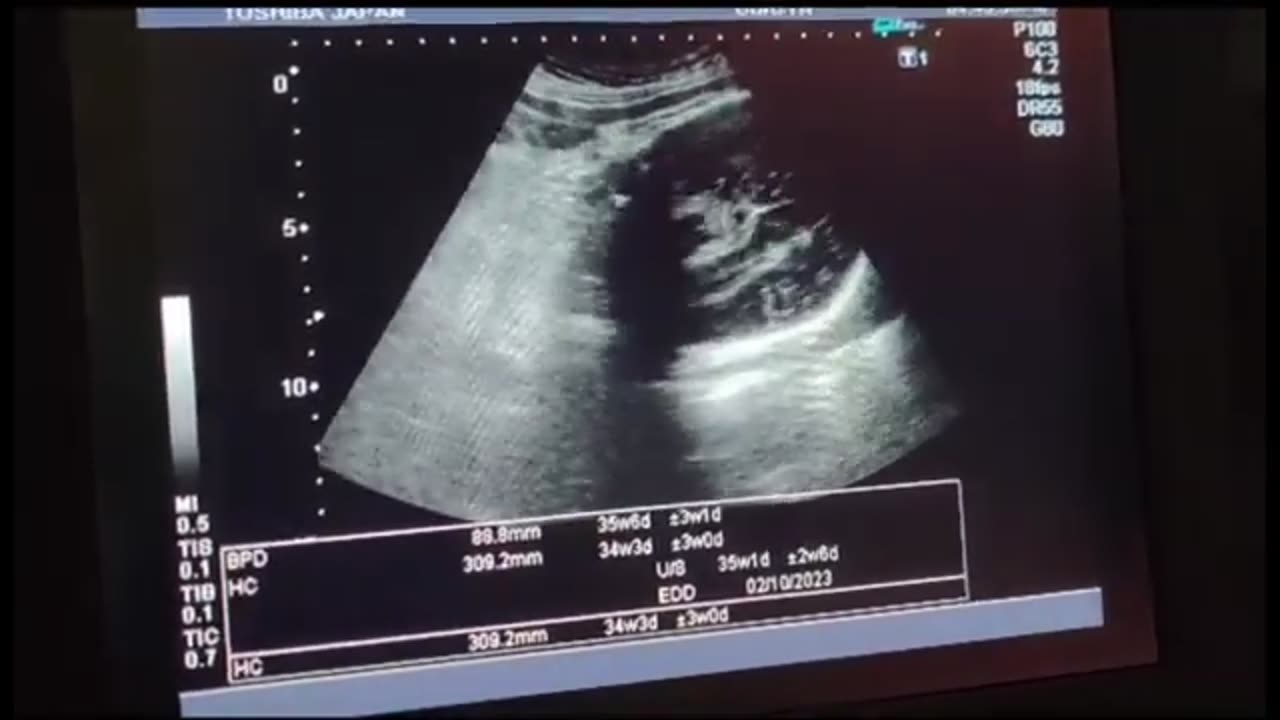 Male Gender After Three Female with Cord Around Neck