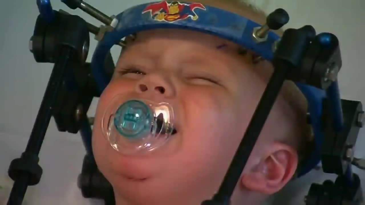 Toddler's head reattached by doctors in medical miracle