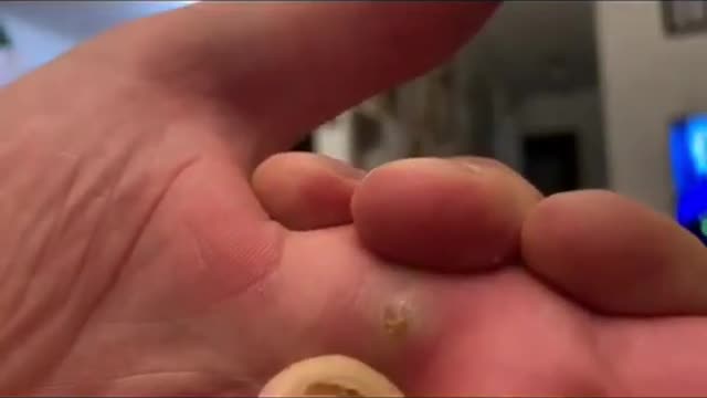 Splinter removal videos compilation