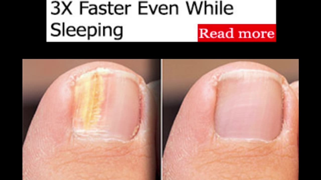 How To Clear Nail Fungus 3X Faster Even While Sleeping?