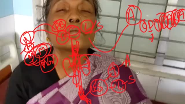 ST5.45 year old lady with difficulty swallowing discussion Jannat_2