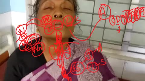 ST5.45 year old lady with difficulty swallowing discussion Jannat_2