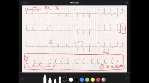 Qual medicação esse paciente está usando baseado nesse ECG